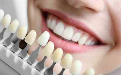 ¿Qué debes saber sobre el Blanqueamiento Dental?