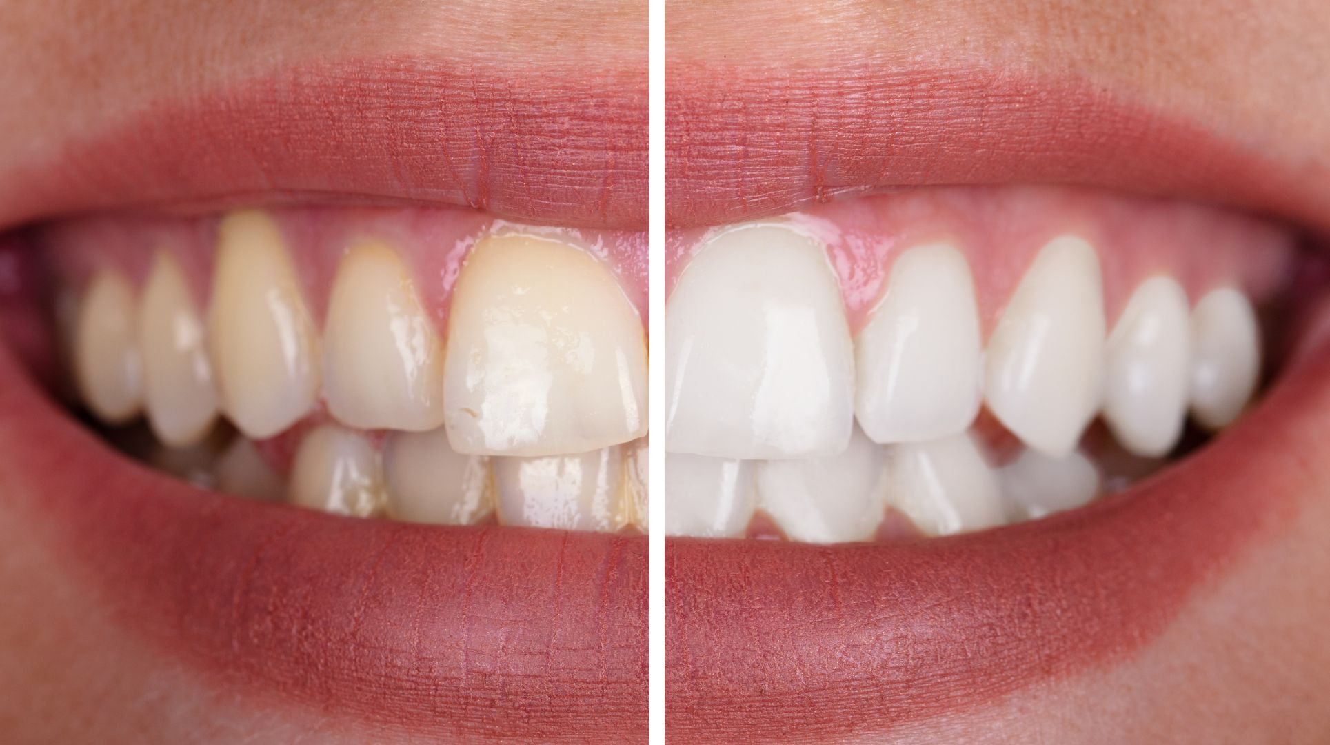 blanqueamiento dental en cordoba