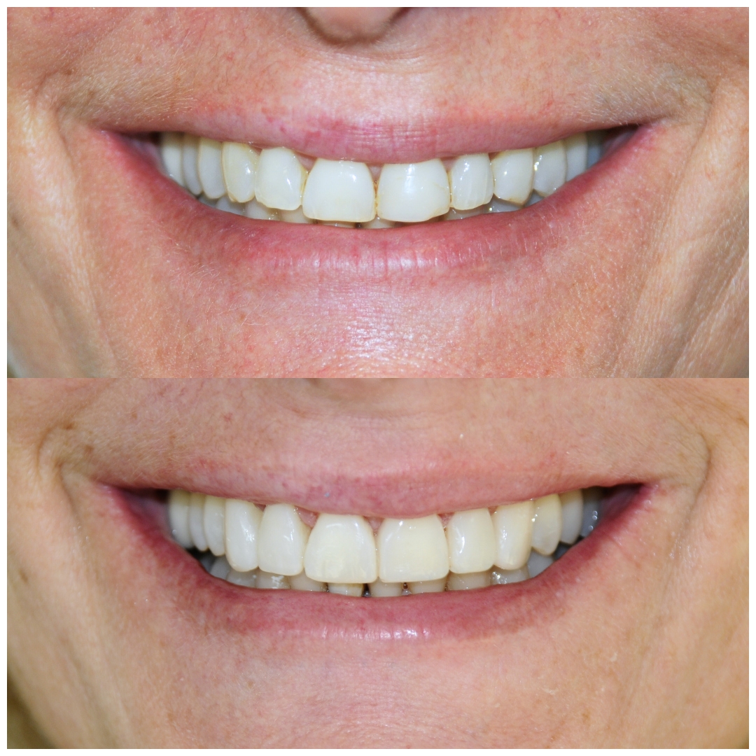 antes y después carillas dentales