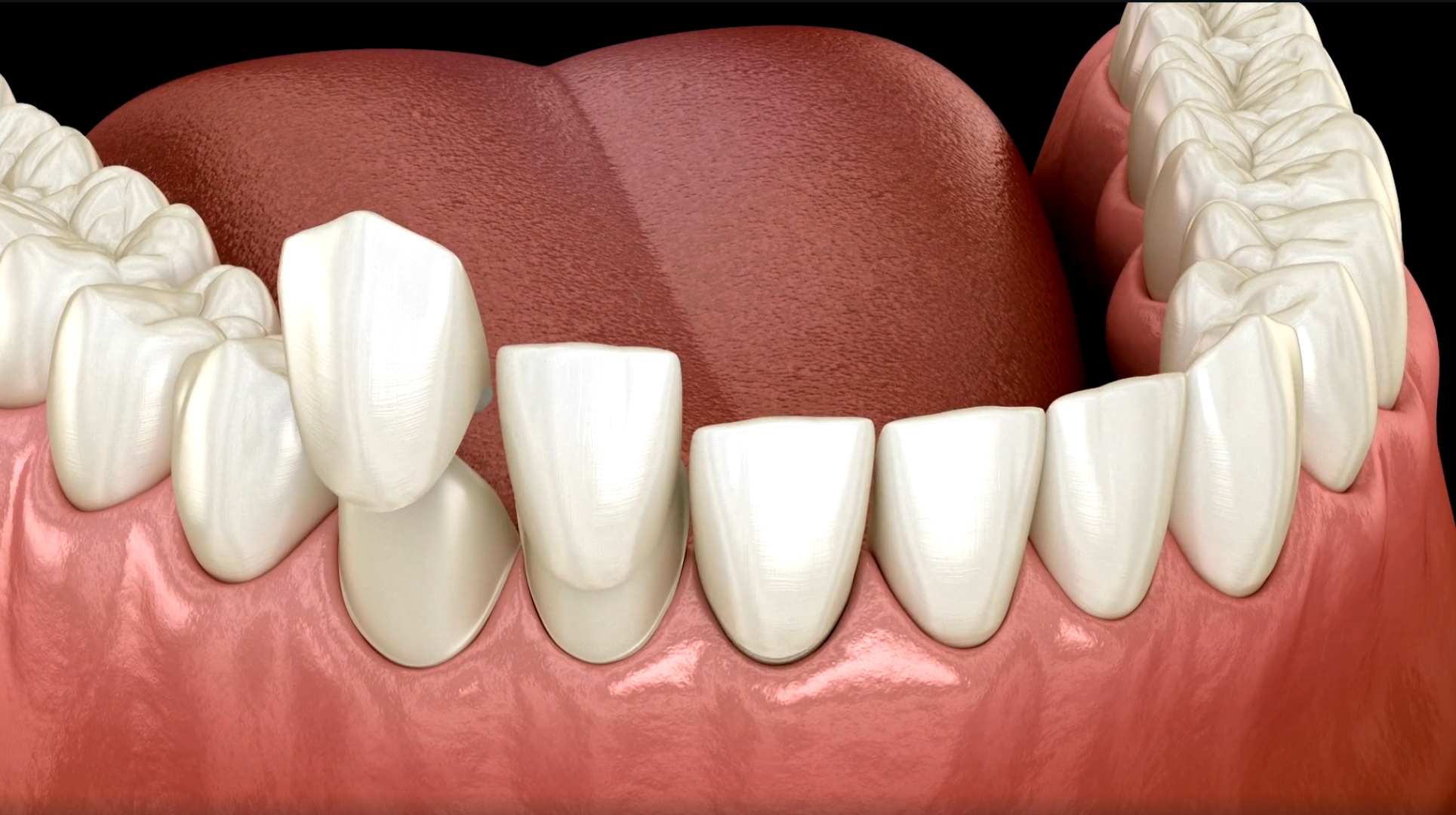 carilla dental
