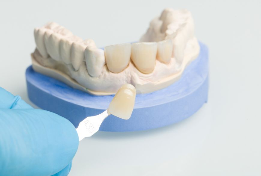 ¿Qué es mejor carillas de composite o de porcelana?