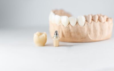 Implantes dentales en un solo día: carga inmediata
