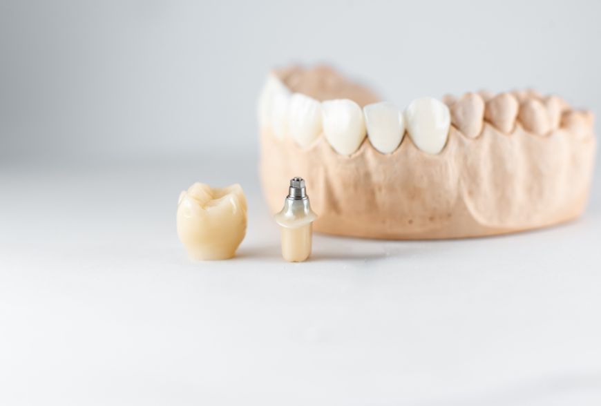 implantes carga inmediata